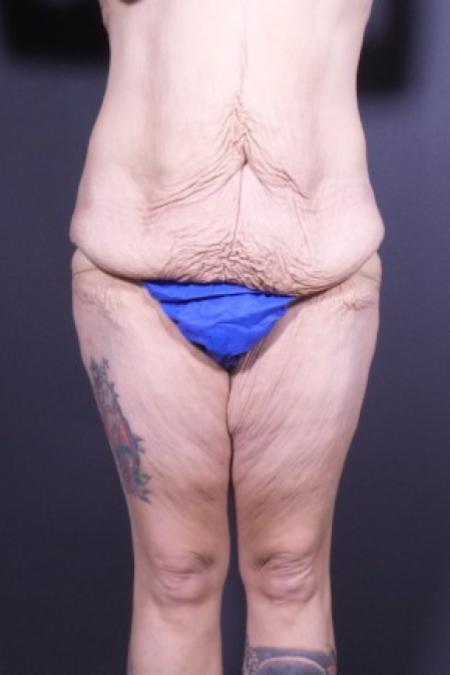 Before image 1 Case #84841 - Bodylift