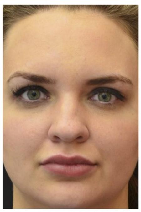 Before image 1 Case #86346 - 25 year old woman treated with nonsurgical rhinoplasty