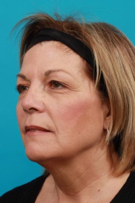 Before image 2 Case #85636 - Face Lift with Upper Blepharoplasty