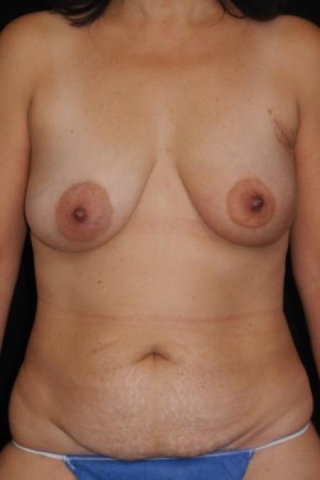 Before image 1 Case #82931 - 57 y/o - Immediate Unilateral Left DIEP Flap Breast Reconstruction