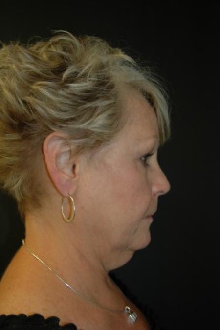 Before image 3 Case #81311 - Facelift, Fat Transfer, Lower Blepharoplasty