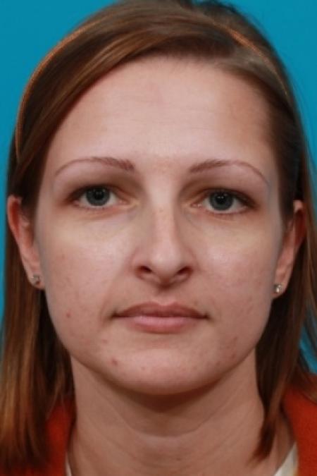 Before image 1 Case #78781 - Rhinoplasty (Nose Reshaping)