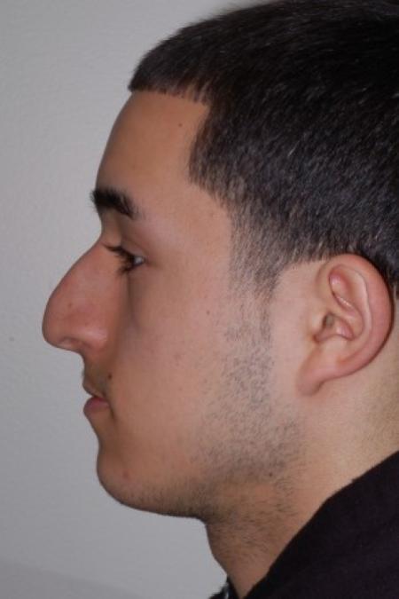 Before image 2 Case #87211 - Rhinoplasty