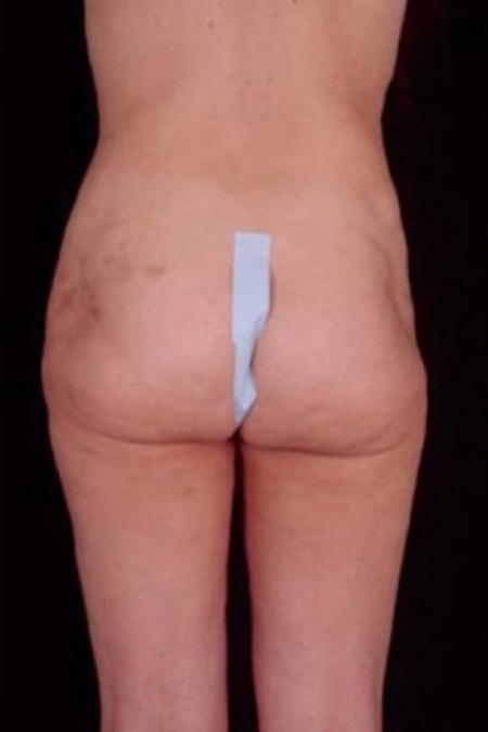 Before image 4 Case #81666 - Liposuction