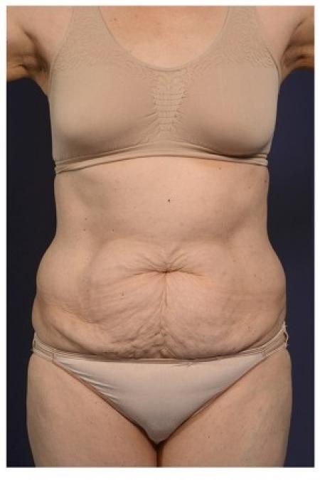 Before image 1 Case #84751 - Abdominoplasty