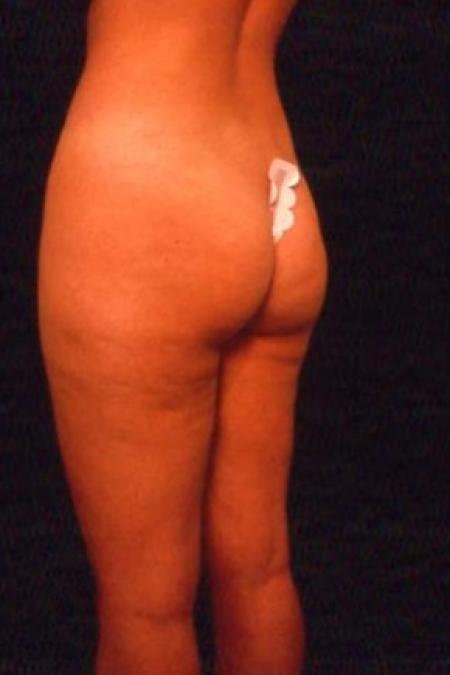 Before image 1 Case #81611 - Liposuction