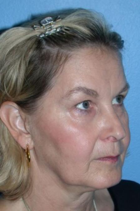 Before image 2 Case #86141 - CO2 Laser For Skin Rejuvenation, Browlift, & Upper Blepharoplasty