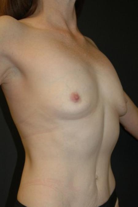 Before image 2 Case #81316 - Breast Augmentation using Allergan Style 15- 286cc