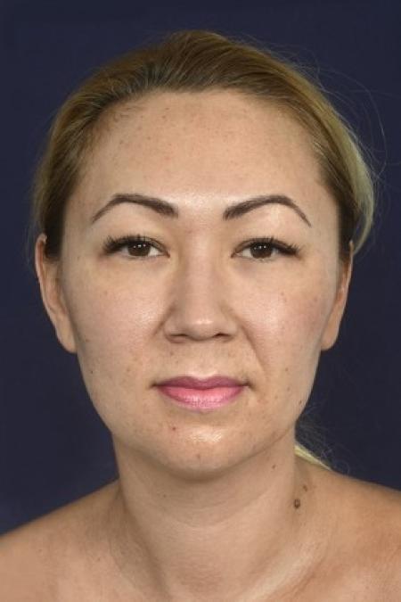 Before image 1 Case #87151 - Neck / Chin Liposuction