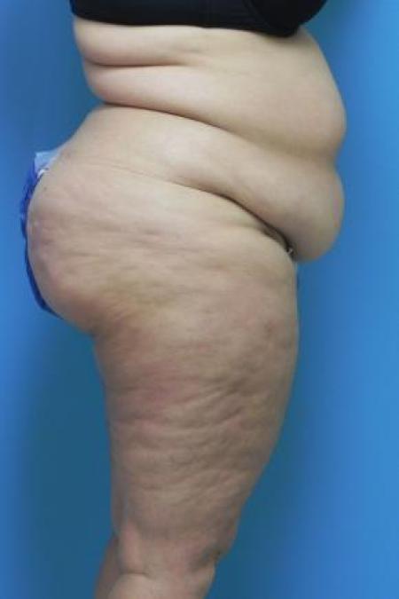 Before Case #80956 - Lower body lift and medial thigh lift