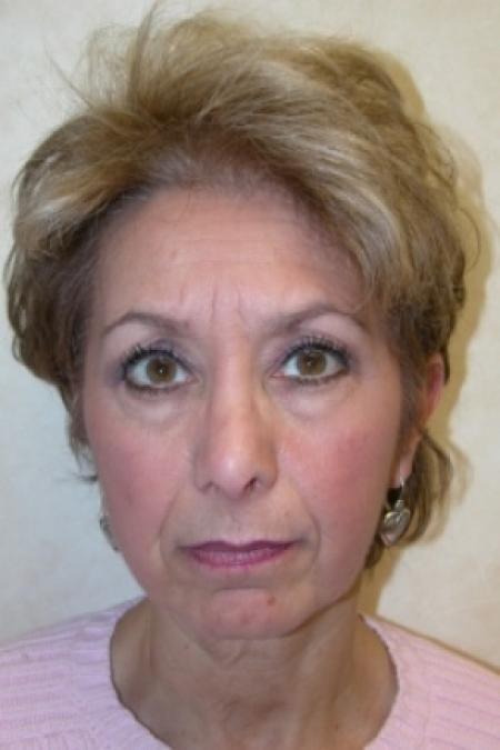 Before image 1 Case #80796 - Facelift