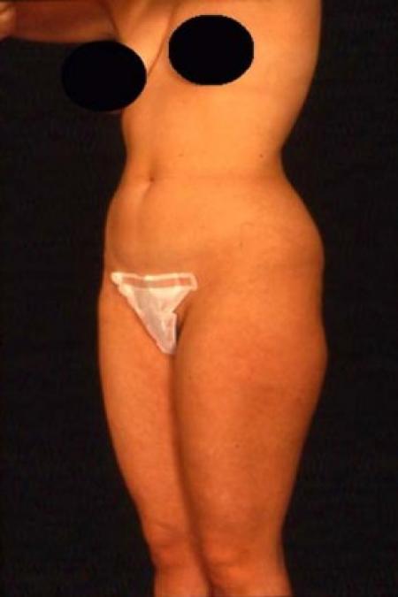 Before image 2 Case #81531 - Liposuction