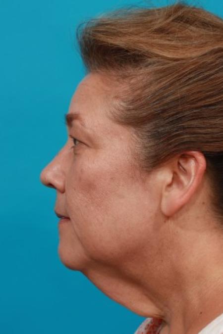 Before image 3 Case #85621 - Neck / Lower Face Lift