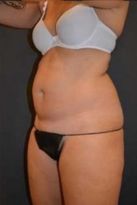 Before image 2 Case #85686 - Tummy Tuck 