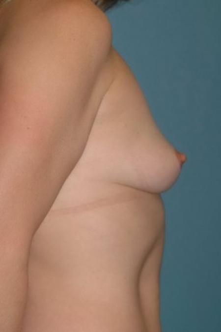 Before image 3 Case #86156 - Breast Augmentation with Silicone Implants