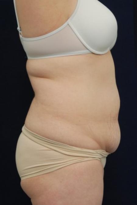 Before image 3 Case #87696 - Abdominoplasty