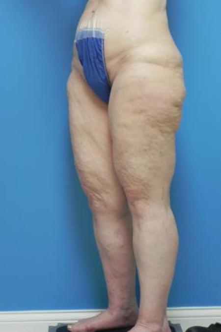 Before Case #80951 - Thigh Lift