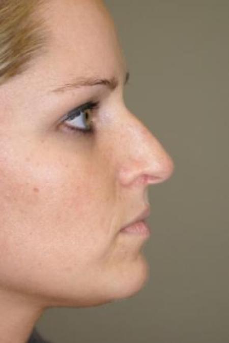 Before image 2 Case #80856 - Rhinoplasty