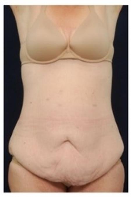Before image 1 Case #81931 - Abdominoplasty