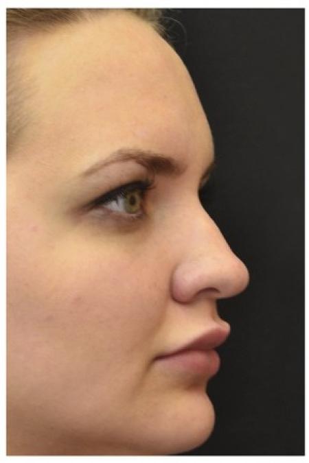 Before image 2 Case #86346 - 25 year old woman treated with nonsurgical rhinoplasty