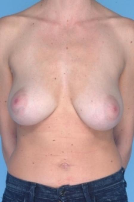 Before image 1 Case #80611 - Breast Reduction 