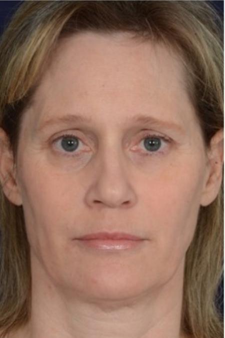 Before image 1 Case #86316 - 50 year old woman treated with nonsurgical rhinoplasty
