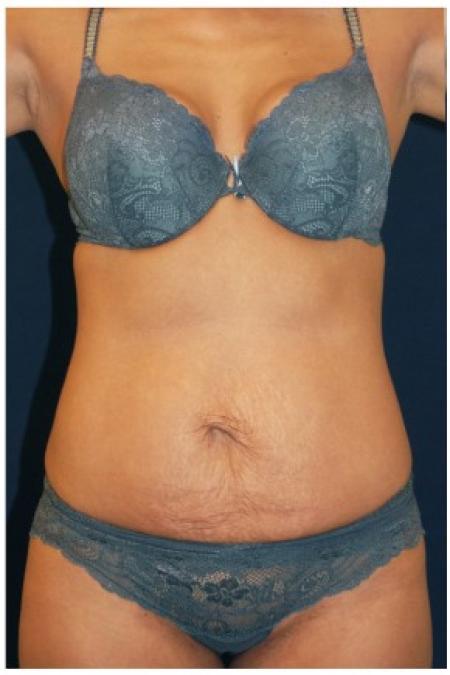 Before image 1 Case #82121 - Tummy Tuck