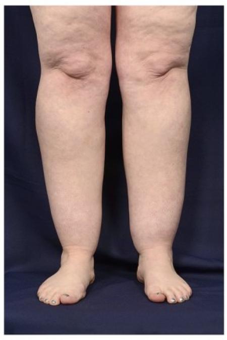 Before image 1 Case #87046 - Lower Leg Liposuction