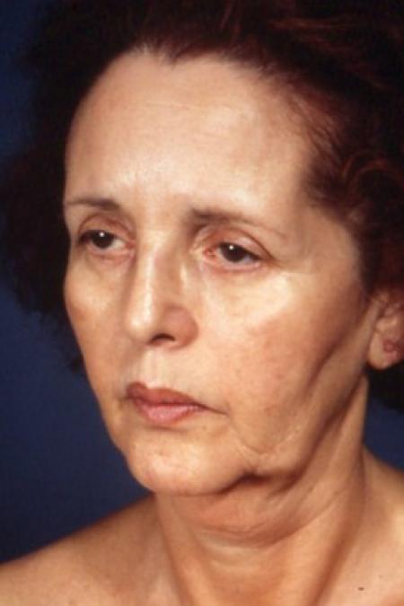 Before image 2 Case #81496 - Facelift