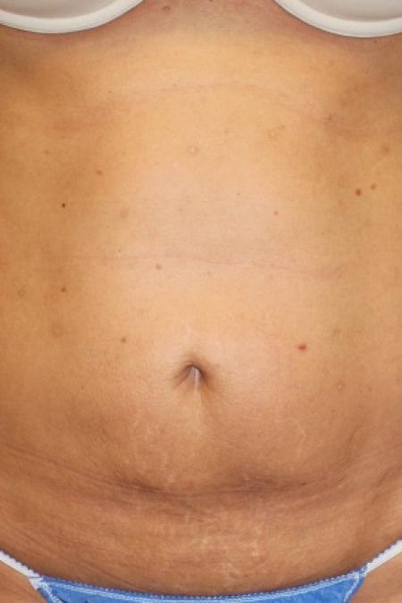 Before image 1 Case #80831 - Liposuction with "mini tummy-tuck"