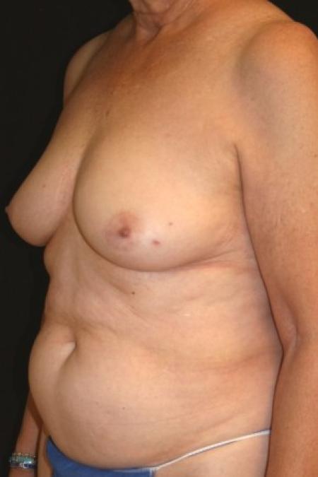 Before image 2 Case #84946 - 72 y/o - Immediate Left DIEP Breast Flap Reconstruction
