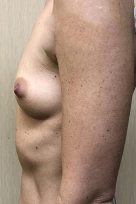 Before image 3 Case #87296 - Silicone Breast Augmentation