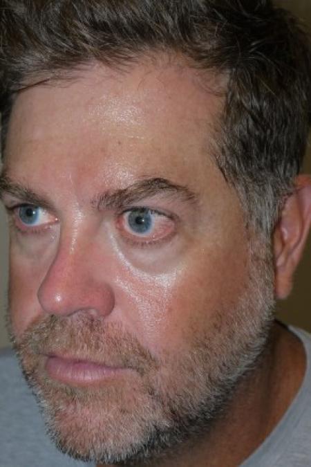 Before image 2 Case #82311 - 43 year old after 3 syringes of Juvederm Voluma for cheeks