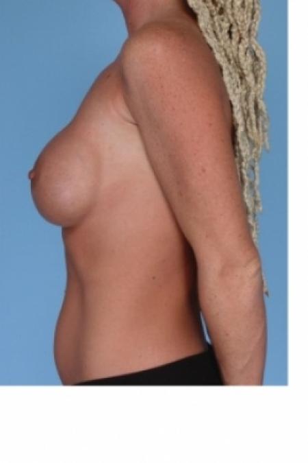 Before image 3 Case #80556 - Breast Implant Replacement