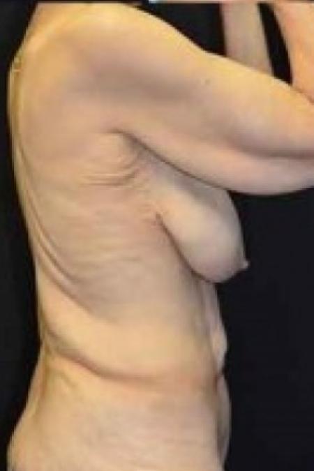 Before image 3 Case #85676 - Tummy Tuck 