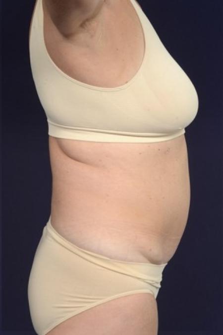 Before image 3 Case #87521 - Trunk Liposuction