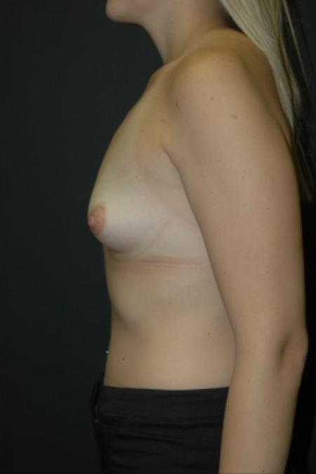 Before image 3 Case #81301 - Sientra Breast Augmentation MP-350cc