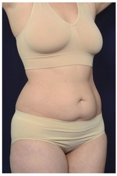 Before image 2 Case #87556 - Abdominoplasty