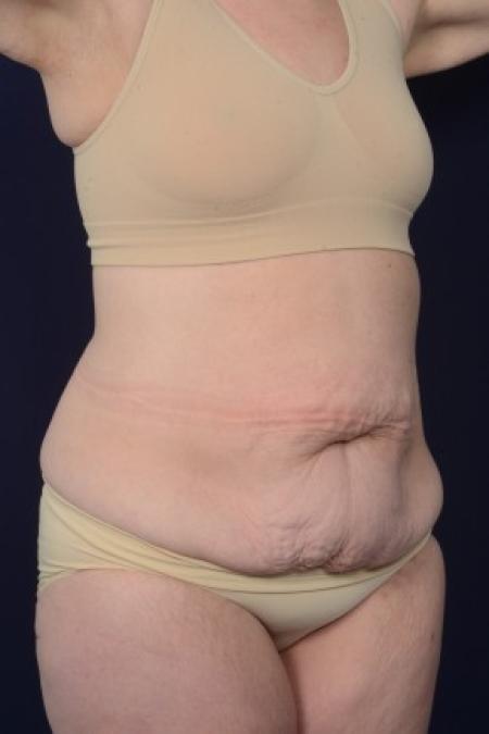 Before image 2 Case #87546 - Abdominoplasty