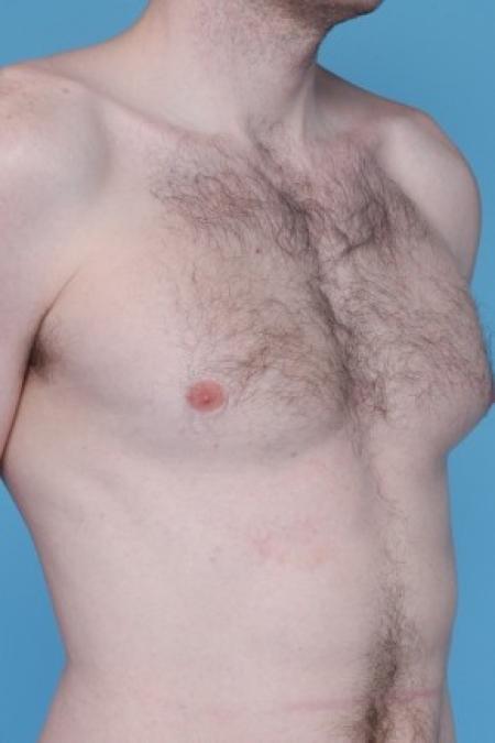 Before image 2 Case #81176 - Male Breast Reduction
