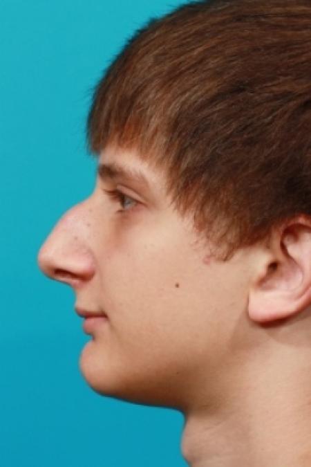 Before image 3 Case #78766 - Rhinoplasty (Nose Reshaping)