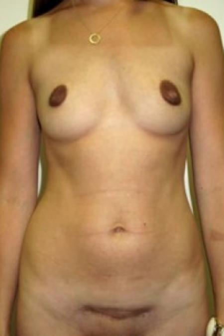 Before image 1 Case #85681 - Mommy Makeover 