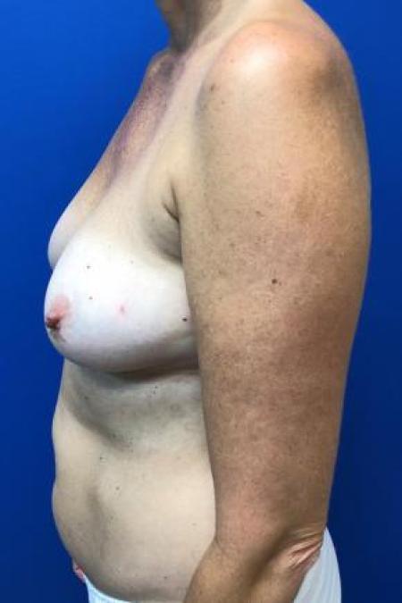 Before image 3 Case #88411 - Breast Reconstruction on a 53 year old female