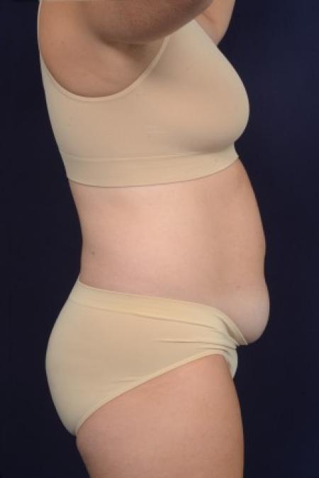 Before image 3 Case #87471 - Abdominoplasty