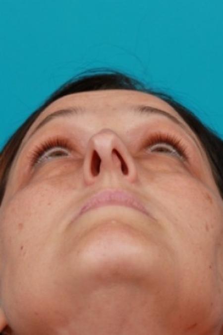Before image 4 Case #81066 - Open Rhinoplasty
