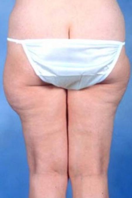 Before image 1 Case #81651 - Liposuction