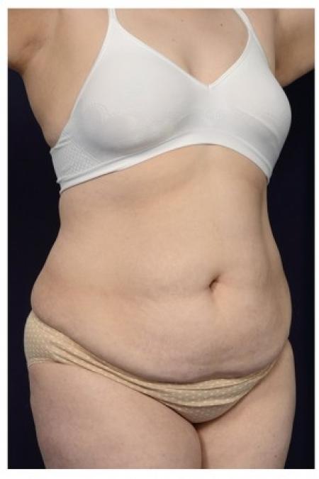 Before image 2 Case #86901 - Abdominoplasty
