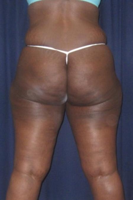 Before Case #82351 - Brazilian Buttock Lift