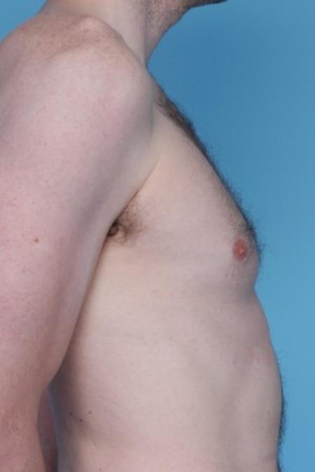 Before image 1 Case #81176 - Male Breast Reduction