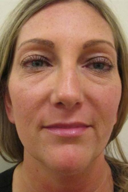 Before image 1 Case #82716 - Fat transfer to Face (39 years old)